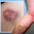 Blood Clot or Bruise? Does a Blood Clot Look Like a Bruise and How to Tell the Difference Early