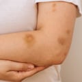What Is Purpura Simplex Rashes and Bruises The Truth You Must Know