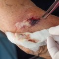 Infected Stitches Pictures With Tips to Prevent Infection