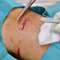 Infected Stitches Warning Signs? Heal Faster With Proven Tips