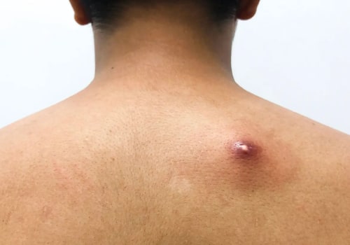 Boil vs Cyst vs Abscess: Spot, Treat, and Heal Fast