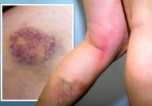 Blood Clot or Bruise? Does a Blood Clot Look Like a Bruise and How to Tell the Difference Early