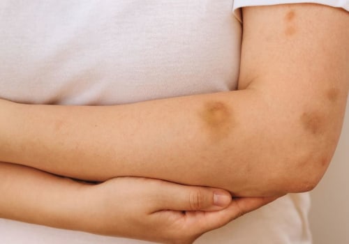 What Is Purpura Simplex Rashes and Bruises The Truth You Must Know