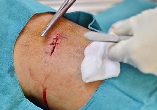 Infected Stitches Warning Signs? Heal Faster With Proven Tips